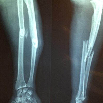 Fracturas